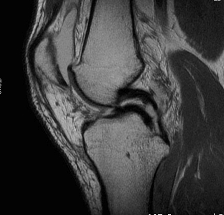 Medial Meniscus Tear Double PCL